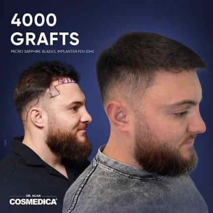 How Is a Natural Hairline Actually Designed? Art Threat